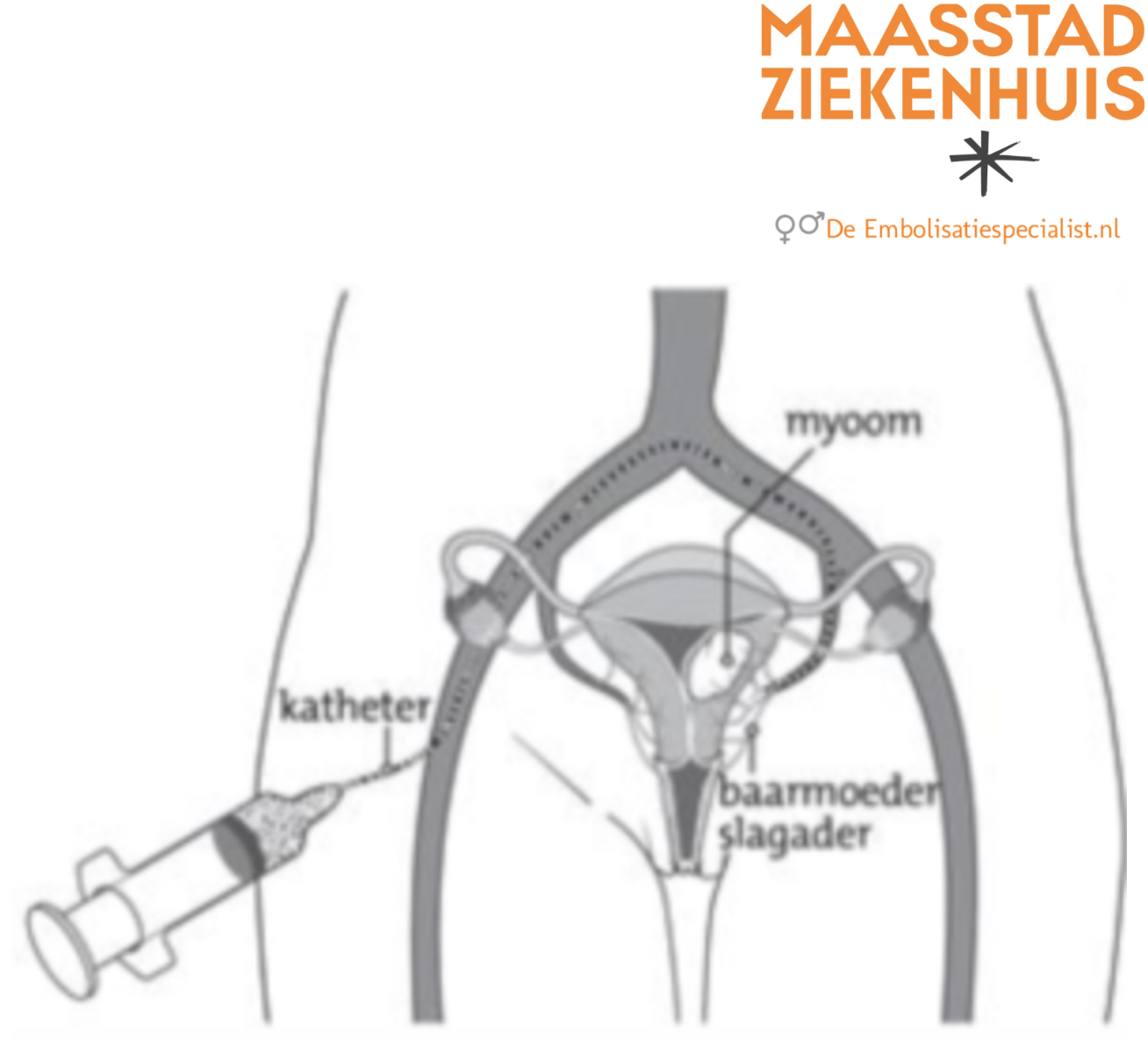 Prostaat embolisatie